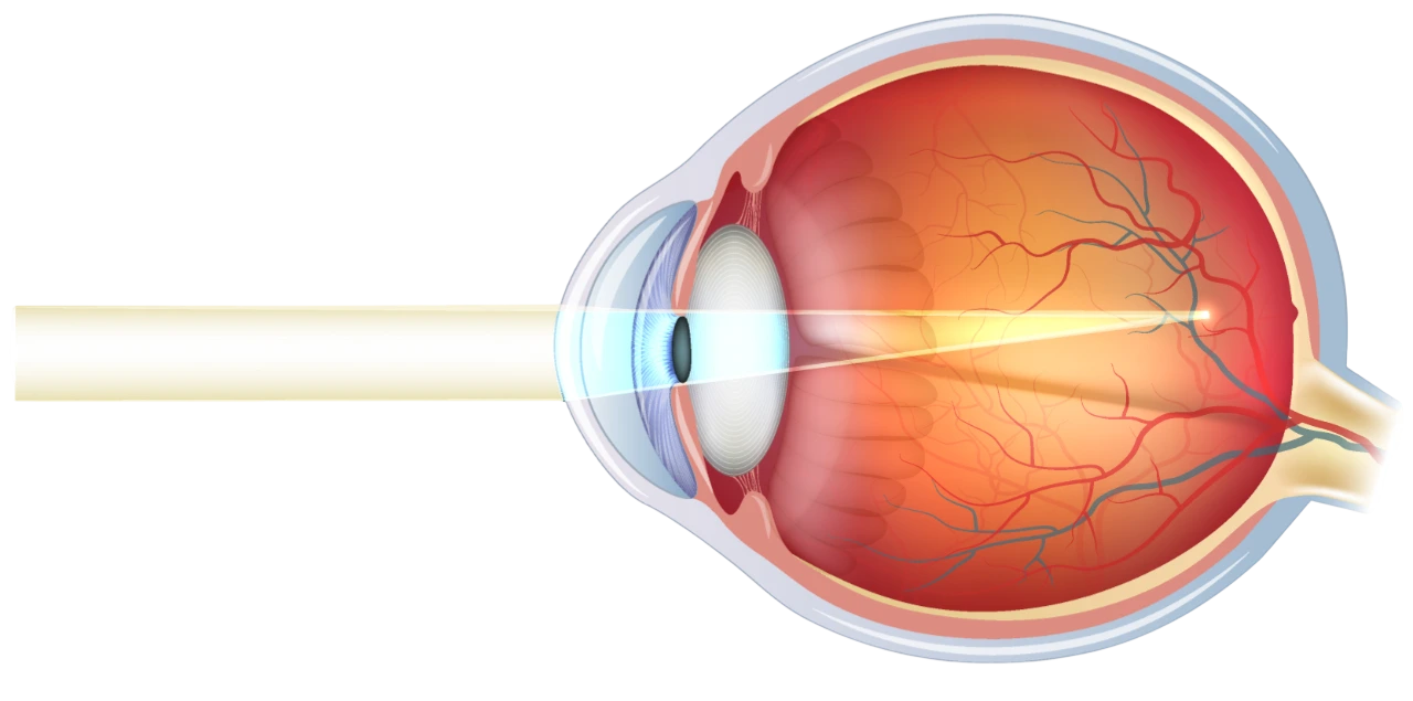 La myopie - Centre Ophtalmologique & Rétine situé à Privas dans l’Ardèche