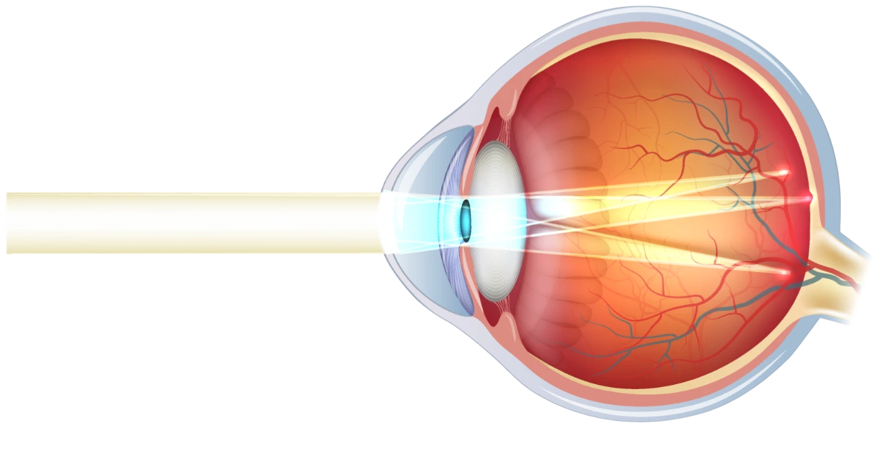 L’astigmatisme - Centre Ophtalmologique & Rétine situé à Privas dans l’Ardèche