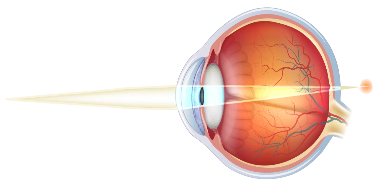 L’hypermétropie - Centre Ophtalmologique & Rétine situé à Privas dans l’Ardèche