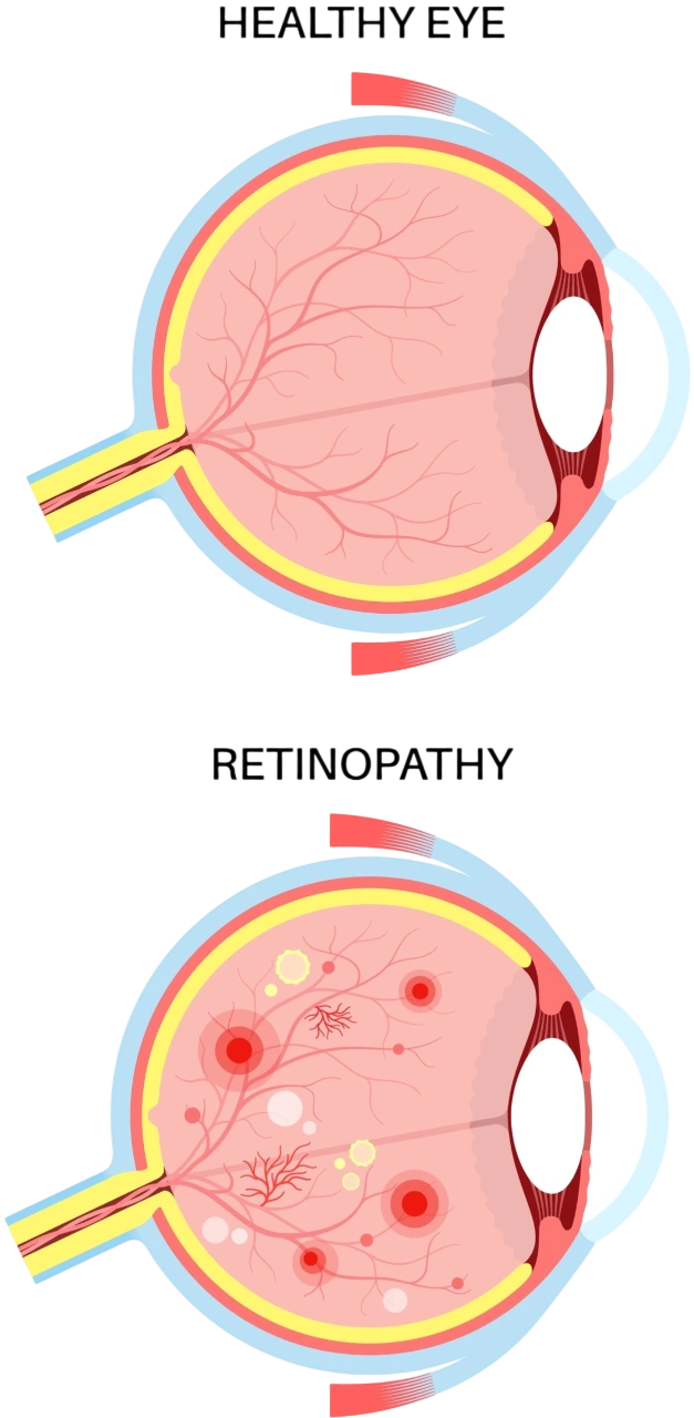 Rétine diabétique - Centre Ophtalmologique & Rétine situé à Privas dans l’Ardèche